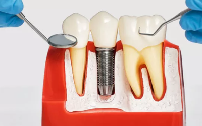 What Is Osseointegration When It Comes To Dental Implants?