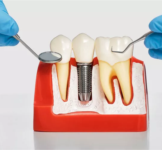 What Is Osseointegration When It Comes To Dental Implants?