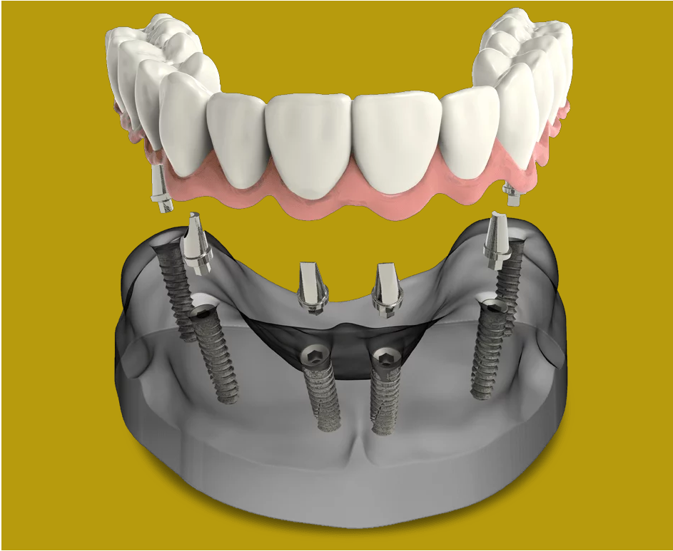 full-mouth-dental-implants2