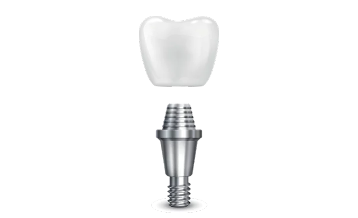 Frame 2147207619 implant