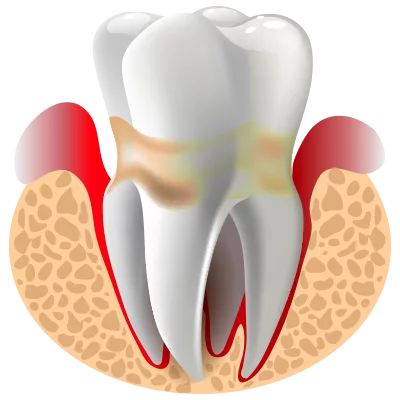 Gum_Diease