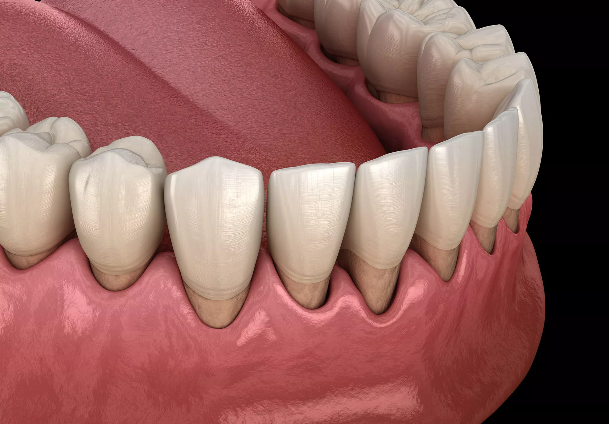 Gum_Recession