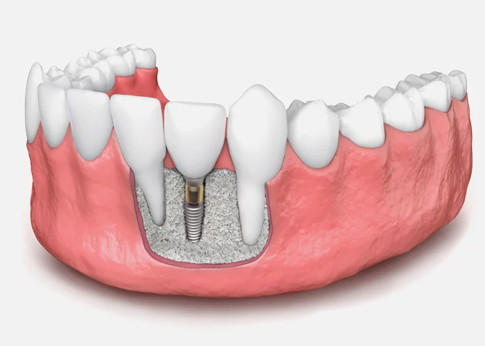 bone-graft-for-dental-implant-model bone-graft-for-dental-implant-model