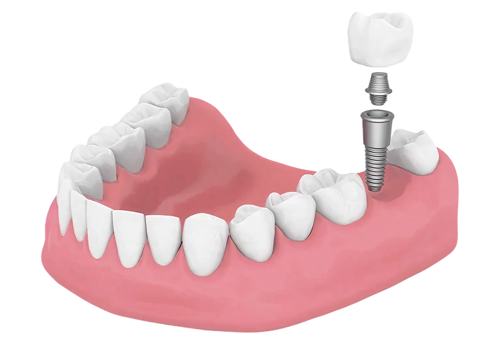 dental-implant-model-1 1 dental-implant-model-